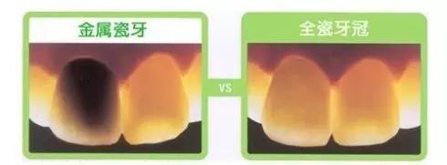 烤瓷牙崩瓷修复的详细步骤,烤瓷牙崩瓷必须更换吗