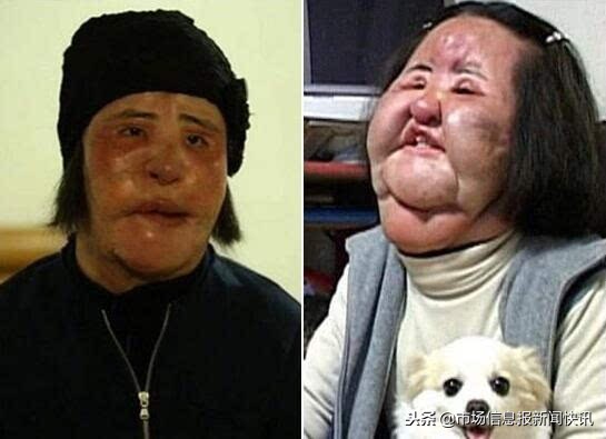 韩国女星整容失败向自己脸注射油,韩国整容背后女性容颜憔悴