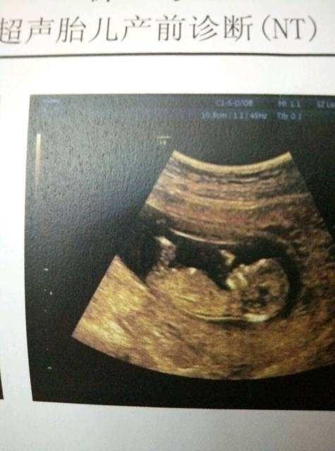 孕17周做唐筛前需要注意哪些,做唐筛之前需要注意什么