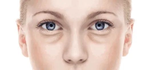 眼袋泪沟黑眼圈卧蚕是怎么形成的,如何分清楚卧蚕泪沟眼袋黑眼圈