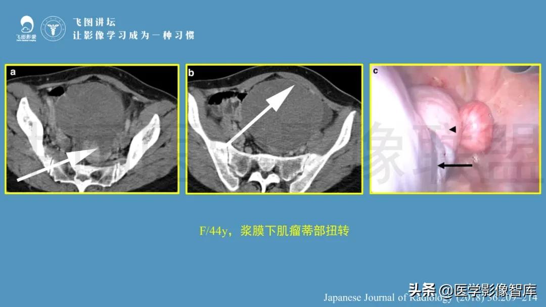 子宫解剖结构输卵管和卵巢位置,子宫附件ct影像学正常解剖表现