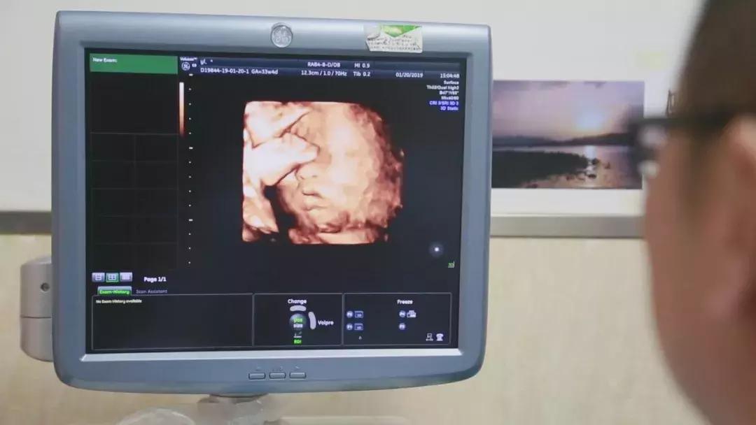 中国首例67岁自然受孕产女,中国首例试管婴儿生下第二代宝宝