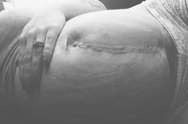 辟谣头胎是剖腹产二胎也必须剖吗,辟谣无痛分娩对胎儿影响大