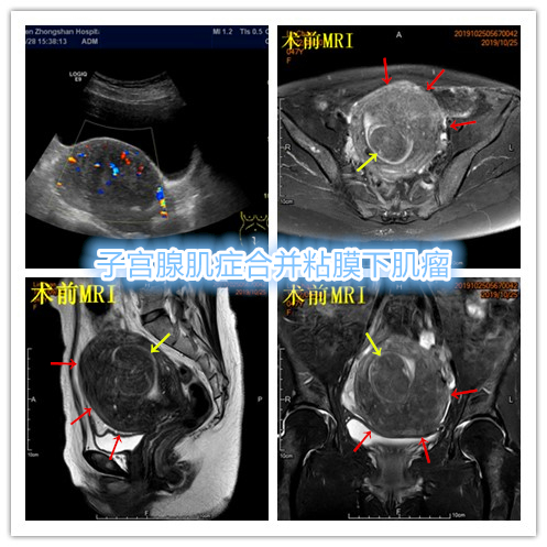 子宫腺肌症「不死的癌症」——介入栓塞来帮忙