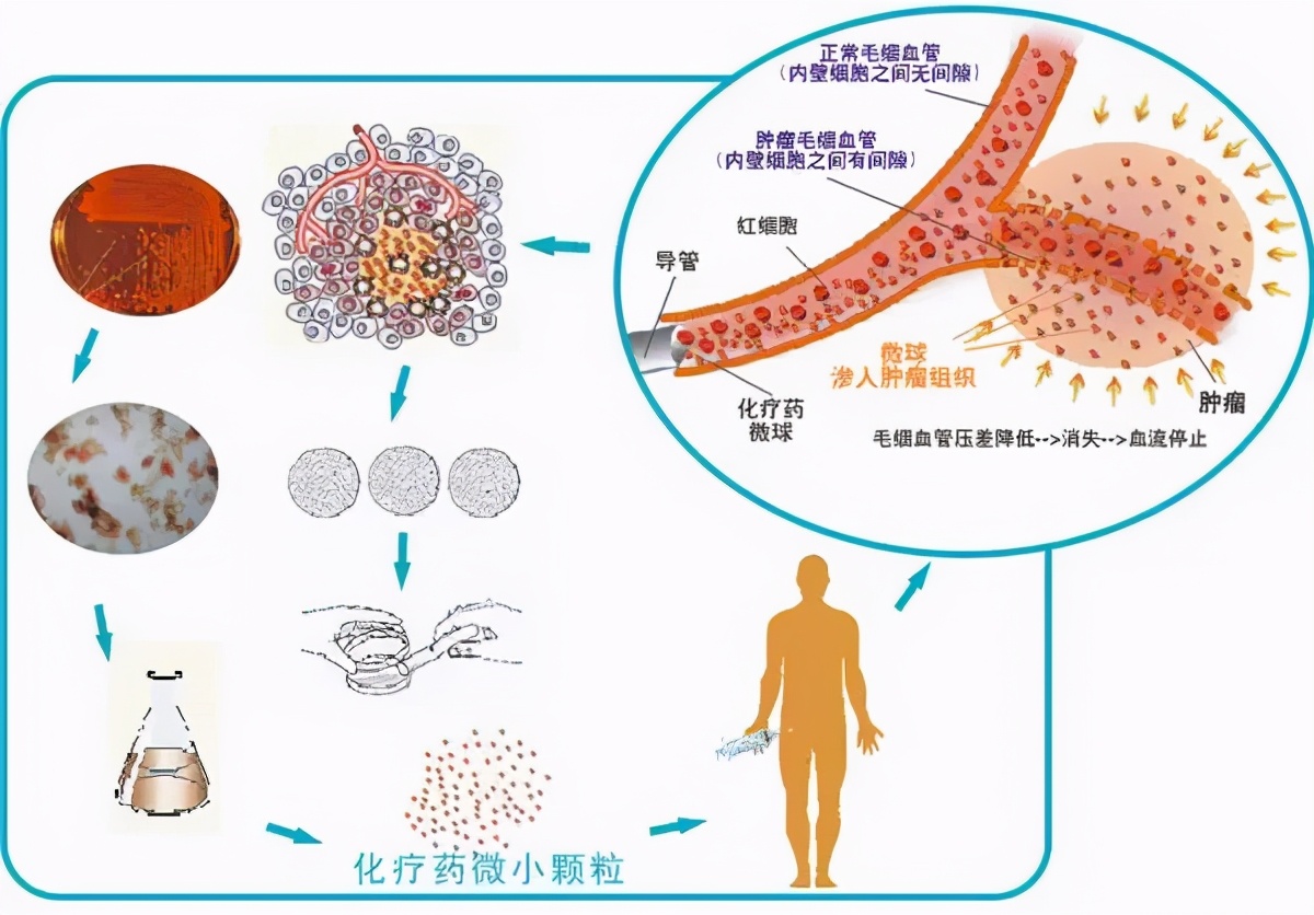 直肠癌为什么会复发和转移,直肠癌复发转移到肝上怎么治疗