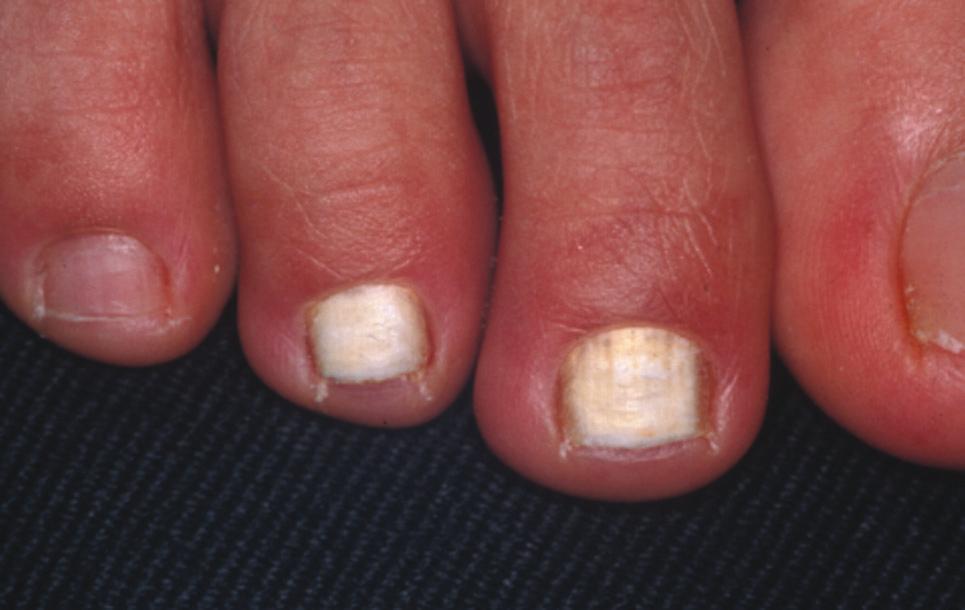 中医治灰指甲杀真菌最好的方法,辟谣灰指甲难治偏方才有效