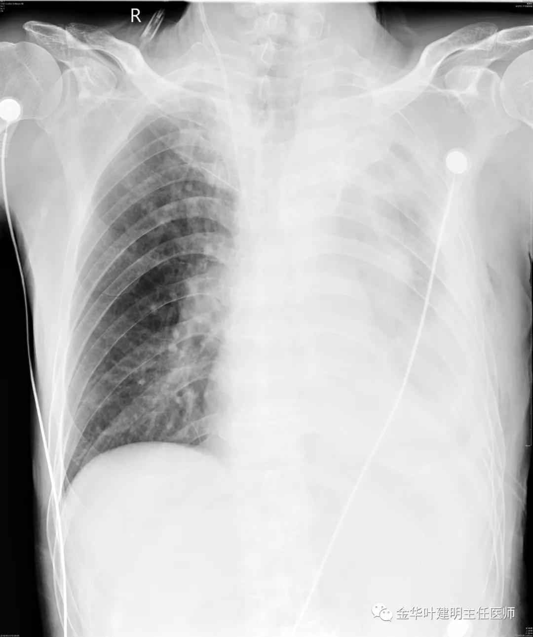 手术引起乳糜胸,有没有做了肺结节手术后是误诊的