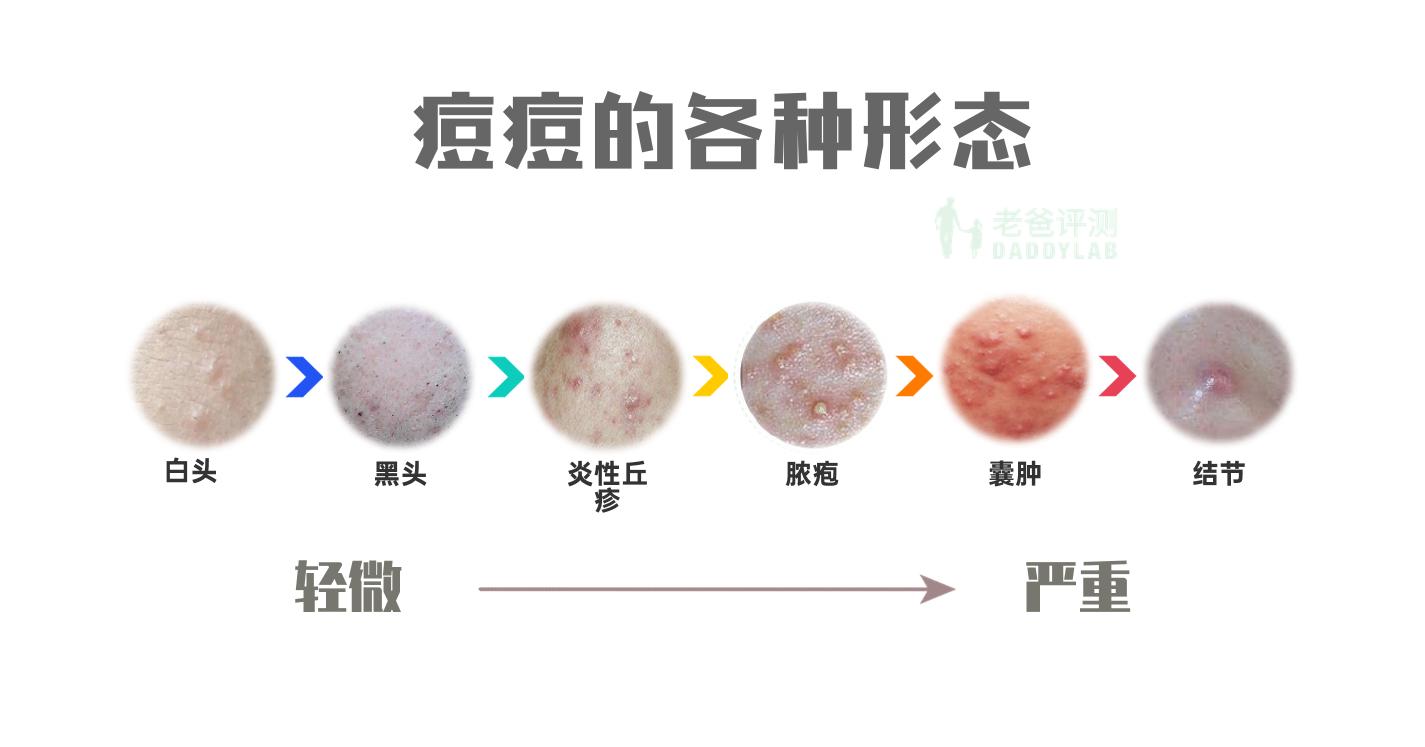 对于即将冒出来的痘痘要怎么抑制,为什么痘痘一定要爆出来才会消除