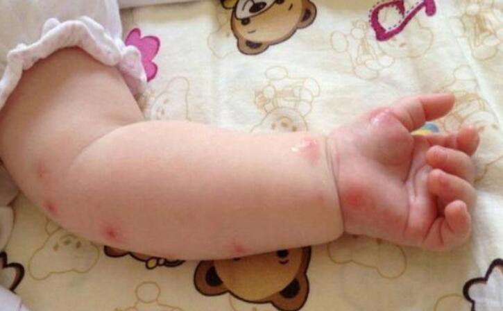 宝宝被蚊子叮咬怎么办,宝宝被蚊子叮咬之后的正确处理