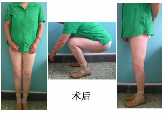 病例：这个患者双膝畸形，无法伸直，活动受限，并有严重骨刺
