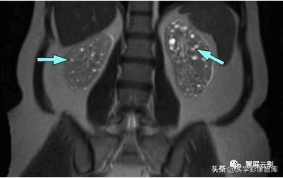 泌尿系统26种症状,泌尿系统的各疾病的体征汇总