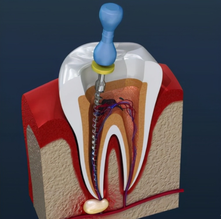 做根管治疗需要注意饮食,根管治疗不当的后果