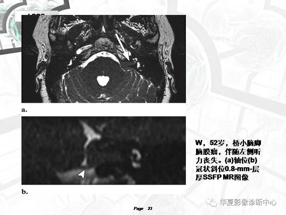 磁共振颅神经扫描是定位在哪,颅神经图谱