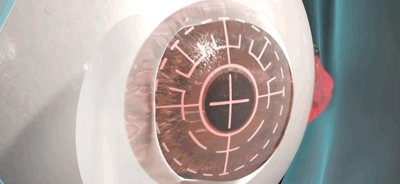 激光近视矫正手术有什么后遗症,激光矫正近视和散光有什么后遗症