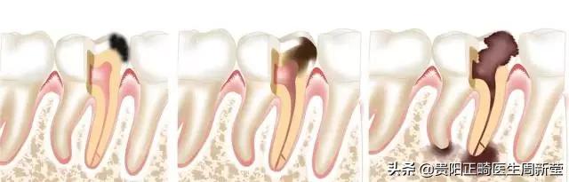 牙疼淋巴肿大是什么原因引起的,牙疼白天不疼晚上疼是什么原因