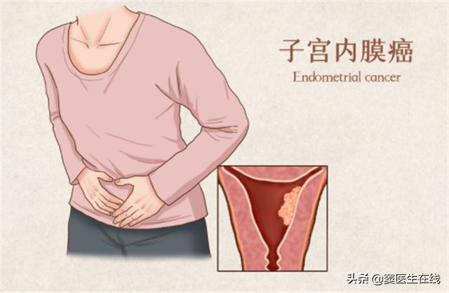 绝经越晚身体衰老得就越慢吗,女性绝经后容易得子宫内膜癌