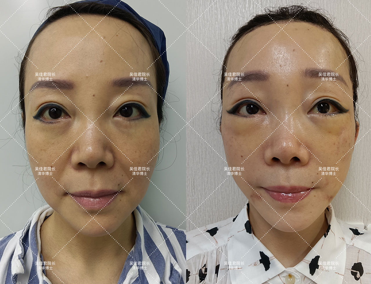 小切口拉皮除皱术适合额头除皱吗,额头缩小大拉皮手术恢复过程