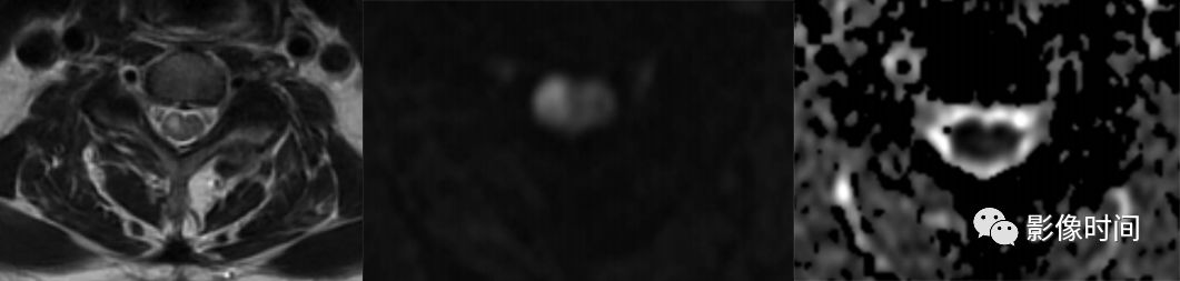 脊髓病变案例图文问诊,脊髓病变视频