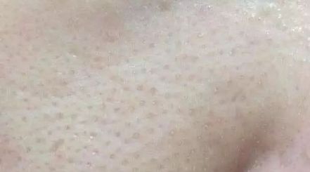 拯救毛孔粗大测评,毛孔粗大拯救全过程