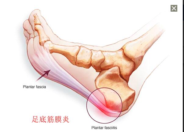 早起下床脚跟痛,早起下床脚踩地脚掌刺痛