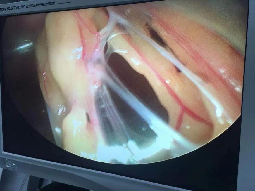 急性盆腔脓肿早期最佳治疗,盆腔脓肿的手术指征