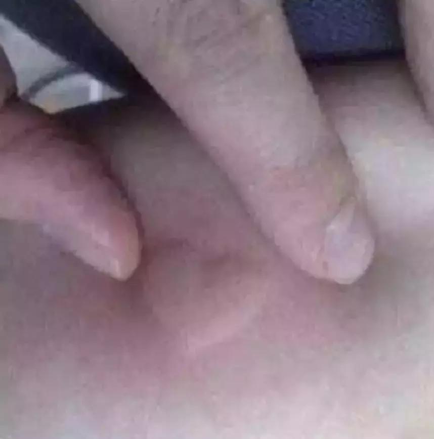 孕妇被蚊子咬了怎么止痒消肿,蚊子咬了止痒消肿最快的办法