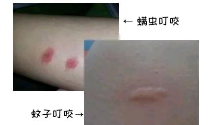 防止毒虫叮咬的最好方法,毒虫叮咬后的救命方法