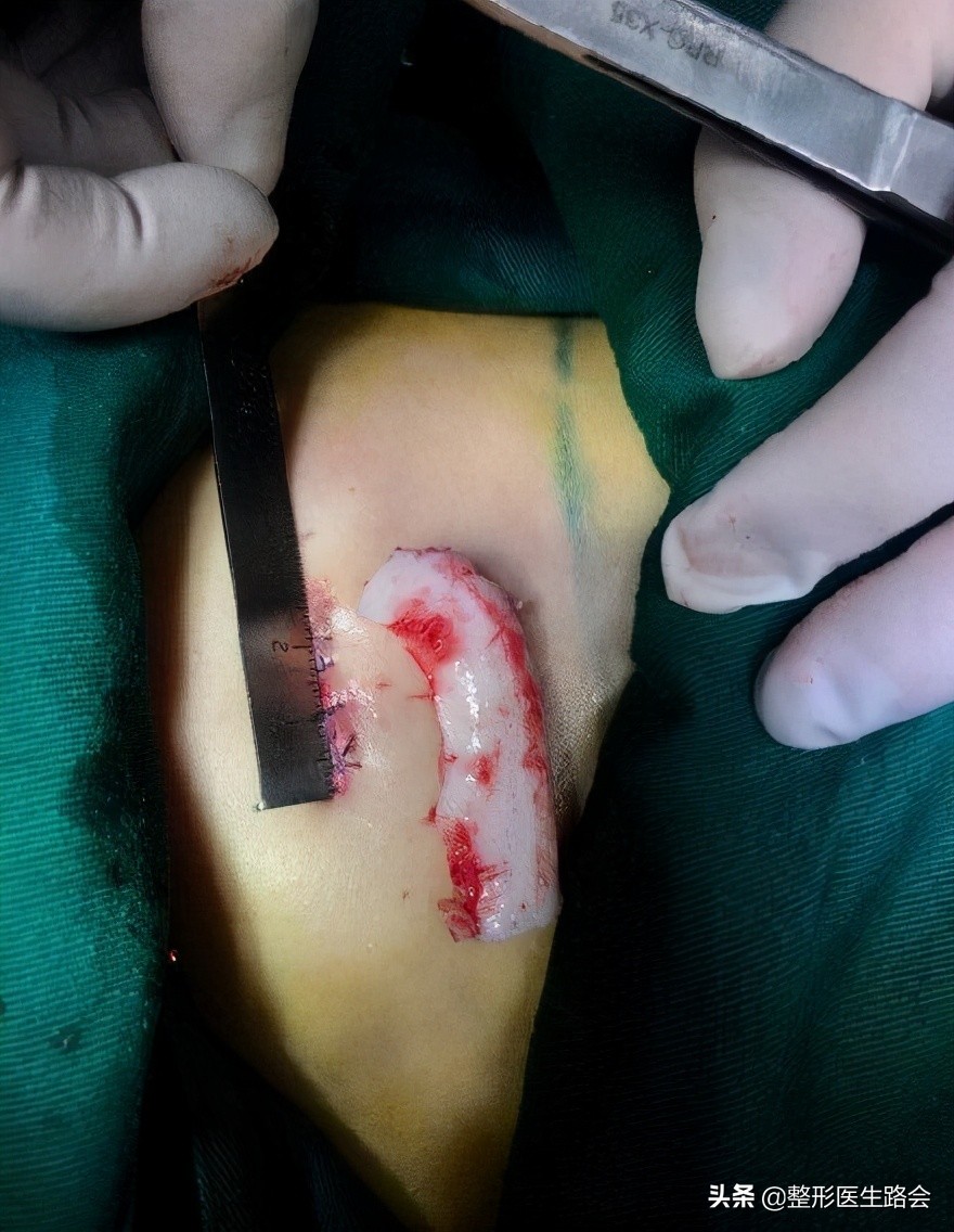 图解详示各种鼻整形方法及过程,鼻整形材料图