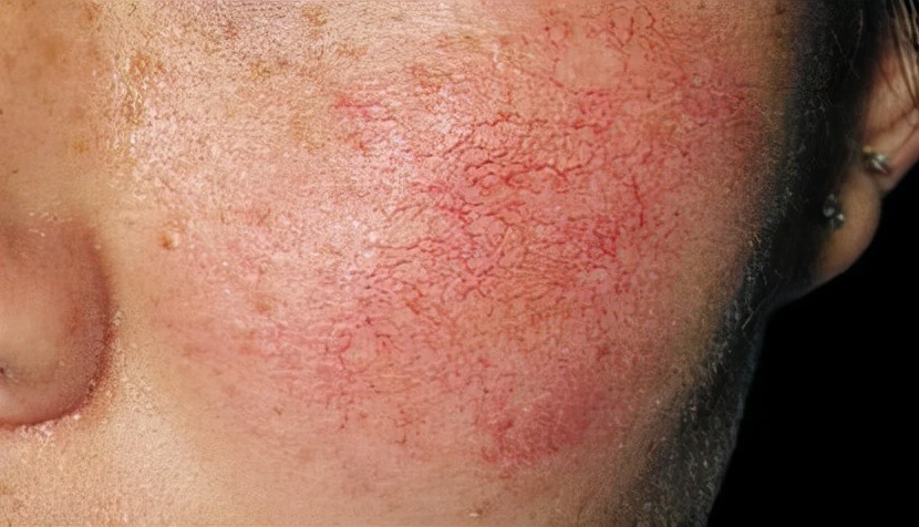 脸上的红血丝要怎样才能去除,脸上的红血丝如何去除