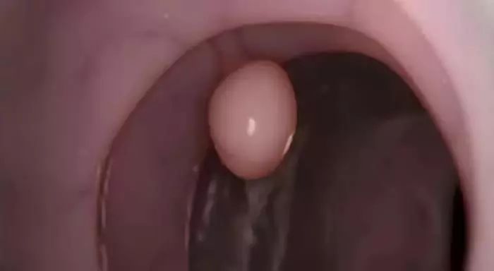 肠息肉切除好还是不切除好,肠息肉切除还是不切除好