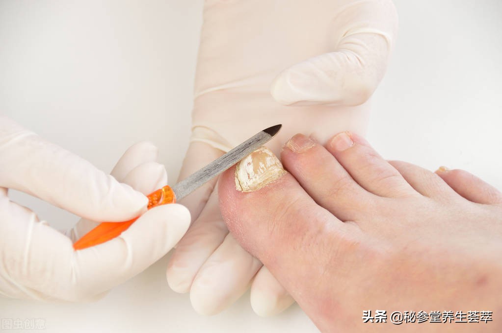 甲沟炎引流排脓疼吗,甲沟炎有脓怎么排脓儿童