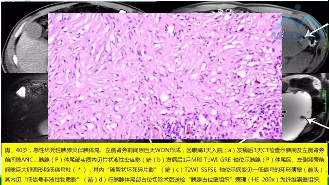 急性胰腺炎的护理措施,急性胰腺炎影像与临床