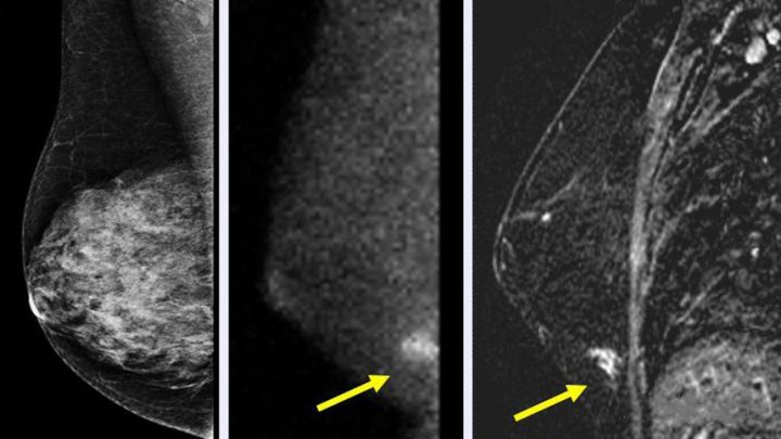 女性打什么针预防癌症,女人怎样预防癌症最有效