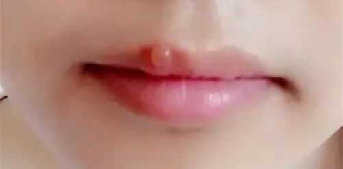 孕妇嘴角长小水泡是不是上火了,孕妇嘴角有泡泡怎么回事