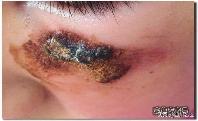 宝宝脸上有疤可以涂芦荟胶吗,小孩脸上有疤痕要抹多久的芦荟胶