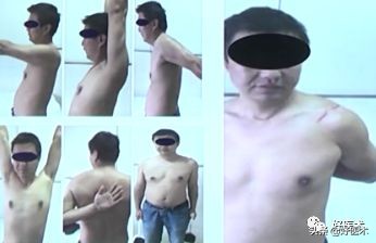 治疗肩锁关节脱位，有最好的方法吗？