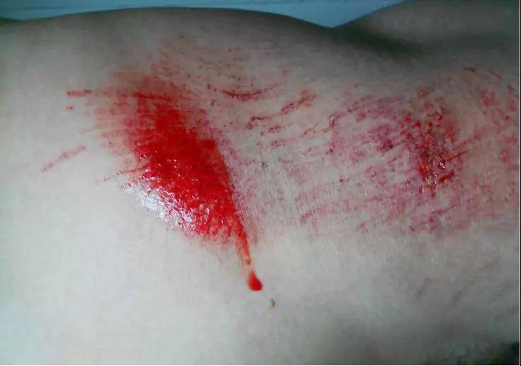 儿童简单外伤的处理方法,如何讲解儿童外伤处理小常识