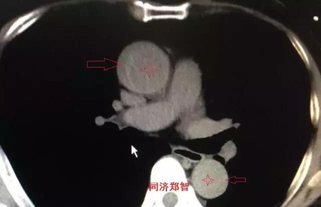 磁共振可以替代cta检查主动脉夹层,超声心动图联合cta诊断主动脉夹层