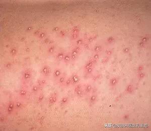 毛囊炎是不是小毛病,皮肤毛囊炎的原因和治疗方法