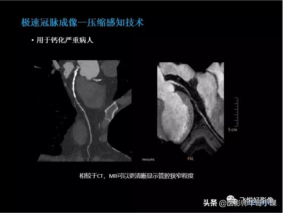 飞利浦核磁共振快速扫描,飞利浦磁共振心脏扫描