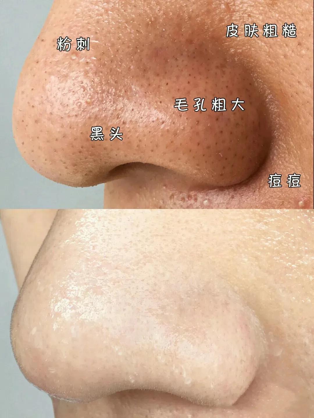 祛鼻头黑头最有效的方法,怎样祛黑头最有效的方法