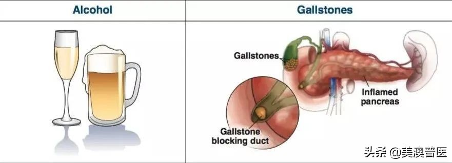 吃海鲜容易得胰腺炎,胰腺炎是胡吃海喝导致的吗