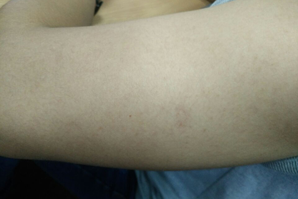 什么是咖啡斑的症状,什么叫咖啡斑