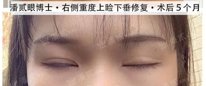 重度上睑下垂术后为什么闭不上眼睛？闭眼不全怎么护理好？