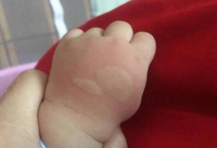 宝宝被蚊子叮咬怎么办,宝宝被蚊子叮咬之后的正确处理