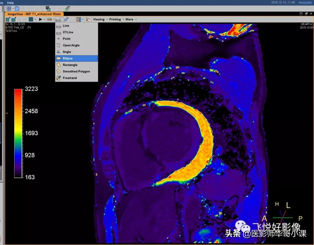 飞利浦磁共振快速扫描方案指南,飞利浦1.5t磁共振各部位扫描技术