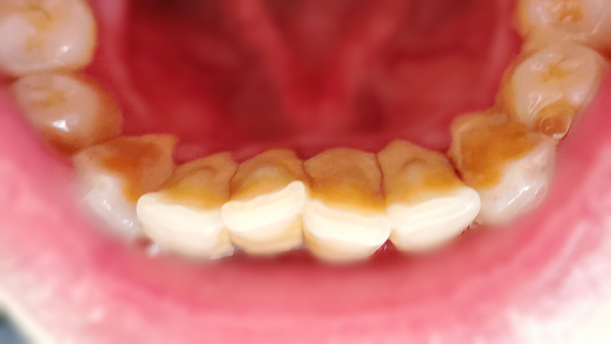 去除牙垢牙刷测评,洁牙神器和普通牙刷哪个好