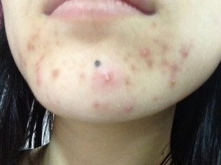 嘴巴下巴红肿痛长痘痘用什么药,下巴长痘痘又痒又痛怎么回事