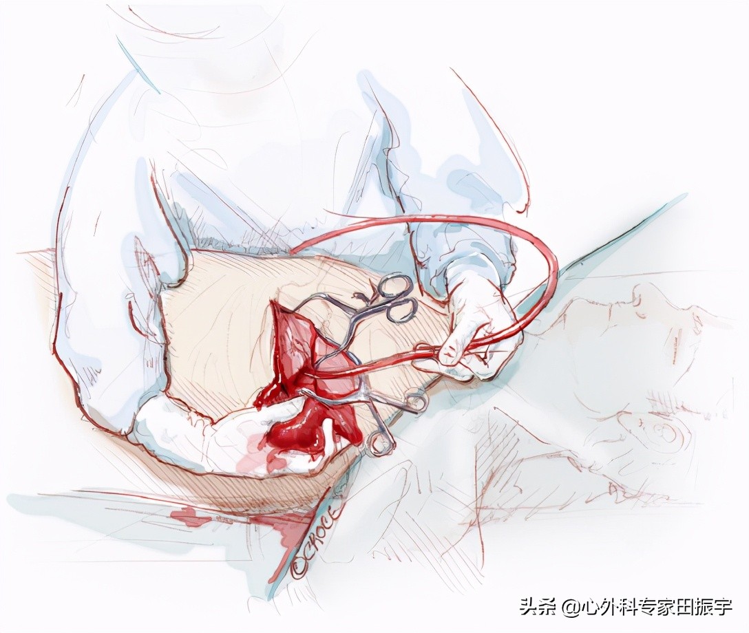 主动脉夹层破裂的院前急救,主动脉夹层破裂的临床表现和处理