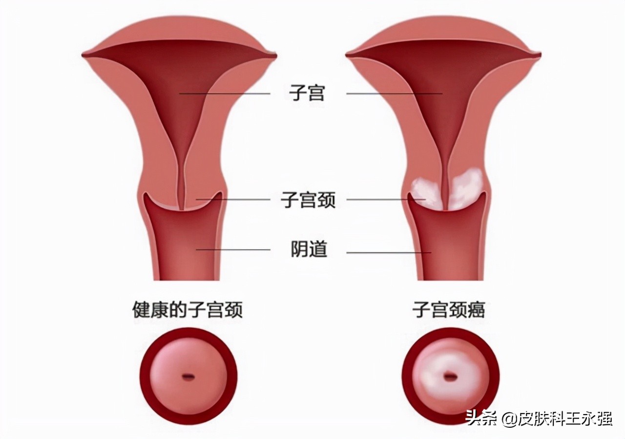 女性腹部隐痛查出宫颈癌,30岁腿痛查出宫颈癌案例